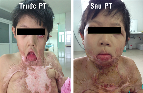 Phẫu thuật tạo hình thành công bệnh nhân sẹo co kéo cằm cổ ngực nặng